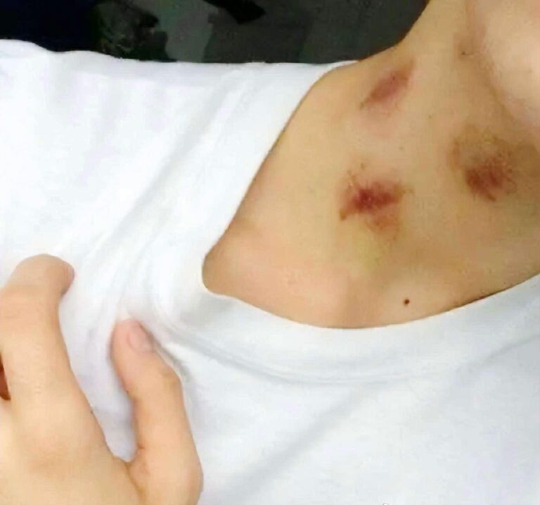 These marks on his neck aren’t love bites